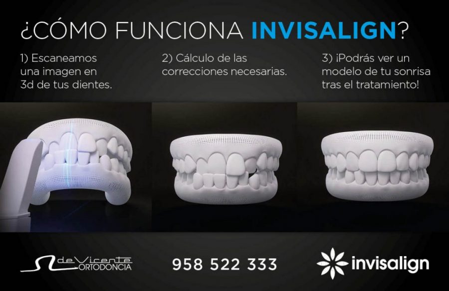 Los secretos de la ortodoncia invisible Invisalign - Clínica Dental De  Vicente Ortodoncia - Periodoncia - Implantes - Estética dental